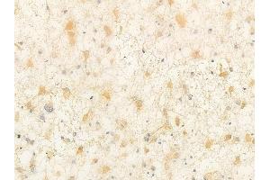 ABIN6262389 and ABIN6266906 at 1/100 staining human astrocytoma by IHC-P. (HSPH1 anticorps  (C-Term))