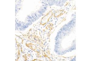 Immunohistochemistry of paraffin-embedded human breast cancer using Decorin Rabbit pAb (ABIN3022360, ABIN3022361, ABIN3022362, ABIN1512816 and ABIN6218761) at dilution of 1:50 (40x lens). (Decorin anticorps  (AA 31-359))