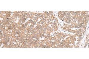 Immunohistochemistry of paraffin-embedded Human liver cancer tissue using PTP4A3 Polyclonal Antibody at dilution of 1:40(x200)