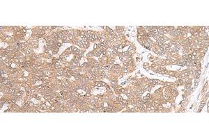 Immunohistochemistry of paraffin-embedded Human liver cancer tissue using PTP4A3 Polyclonal Antibody at dilution of 1:40(x200) (PTP4A3 anticorps)