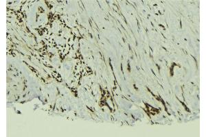 ABIN6273019 at 1/100 staining Human breast cancer tissue by IHC-P. (TAF12 anticorps  (N-Term))