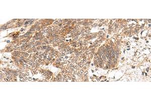 Immunohistochemistry of paraffin-embedded Human esophagus cancer tissue using GRASP Polyclonal Antibody at dilution of 1:150(x200) (Tamalin/GRASP anticorps)
