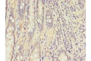 Immunohistochemistry of paraffin-embedded human colon cancer using ABIN7148658 at dilution of 1:100 (CKB anticorps  (AA 2-270))