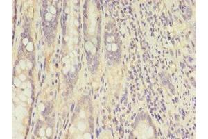 Immunohistochemistry of paraffin-embedded human colon cancer using ABIN7148658 at dilution of 1:100 (CKB anticorps  (AA 2-270))