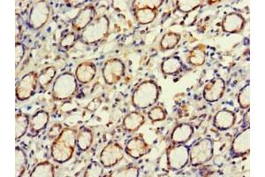 Immunohistochemistry of paraffin-embedded human gastric cancer using ABIN7152269 at dilution of 1:100 (EXD2 anticorps  (AA 137-245))