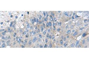 Immunohistochemistry of paraffin-embedded Human liver cancer tissue using KIAA0556 Polyclonal Antibody at dilution of 1:70(x200) (KIAA0556 anticorps)