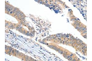 The image on the left is immunohistochemistry of paraffin-embedded Human colon cancer tissue using ABIN7189848(APOB Antibody) at dilution 1/10, on the right is treated with synthetic peptide.