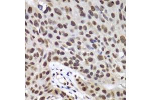 Immunohistochemistry of paraffin-embedded human lung cancer using DDX5 antibody.
