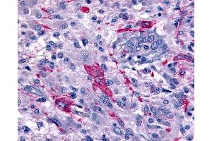 Anti-GPR45 antibody IHC of human Brain, Glioblastoma. (GPR45 anticorps  (Extracellular Domain))