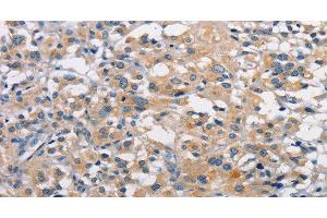 Immunohistochemistry of paraffin-embedded Human thyroid cancer using PKC epsilon Polyclonal Antibody at dilution of 1:50 (PKC epsilon anticorps)