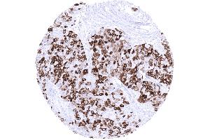 Breast Invasive breast cancer of no special type NST with variable mammaglobin immunostaining in tumor cells mosaic pattern (Recombinant Mammaglobin anticorps)