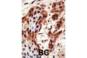 Formalin-fixed and paraffin-embedded human cancer tissue reacted with GJB6 polyclonal antibody  , which was peroxidase-conjugated to the secondary antibody, followed by AEC staining. (GJB6 anticorps  (N-Term))