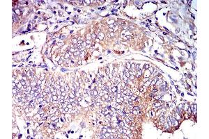 Immunohistochemical analysis of paraffin-embedded endometrial cancer tissues using CD102 mouse mAb with DAB staining. (ICAM2 anticorps  (AA 25-223))