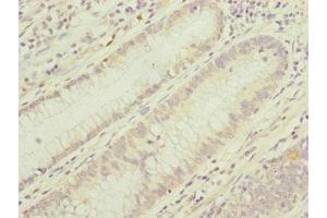 Immunohistochemistry of paraffin-embedded human colon cancer using ABIN7159903 at dilution of 1:100 (TIMM17B anticorps  (AA 1-172))