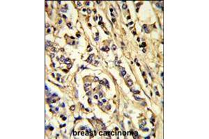 Formalin-fixed and paraffin-embedded human breast carcinoma reacted with VGFR2 Antibody, which was peroxidase-conjugated to the secondary antibody, followed by DAB staining. (VEGFR2/CD309 anticorps)