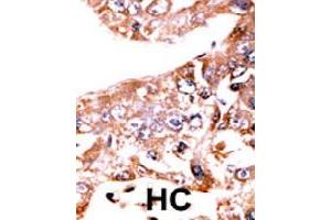 Formalin-fixed and paraffin-embedded human hepatocellular carcinoma tissue reacted with STAT1 (phospho S727) polyclonal antibody  which was peroxidase-conjugated to the secondary antibody followed by AEC staining.