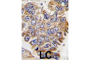 Formalin-fixed and paraffin-embedded human lung carcinoma tissue reacted with GRB2 polyclonal antibody  , which was peroxidase-conjugated to the secondary antibody, followed by DAB staining. (GRB2 anticorps  (Tyr209))