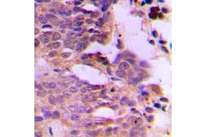 Immunohistochemical analysis of SIAH1/2 staining in human breast cancer formalin fixed paraffin embedded tissue section. (SIAH1/2 anticorps  (Center))