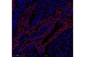 Immunofluorescence of paraffin embedded human gastric cancer using HSP60 (ABIN7074167) at dilution of 1: 1500 (300x lens)