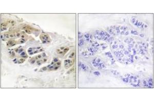Immunohistochemistry analysis of paraffin-embedded human breast carcinoma tissue, using Mammaglobin Antibody. (Mammaglobin anticorps  (AA 41-90))
