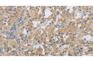 Immunohistochemistry of paraffin-embedded Human thyroid cancer tissue using PKD1 Polyclonal Antibody at dilution 1:40
