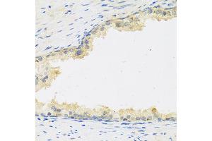 Immunohistochemistry of paraffin-embedded human prostate using LIF antibody at dilution of 1:100 (40x lens). (LIF anticorps)