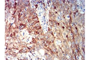 Immunohistochemical analysis of paraffin-embedded stomach cancer tissues using ALDH1A1 mouse mAb with DAB staining.