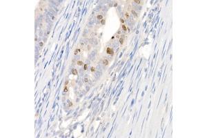Immunohistochemistry of paraffin-embedded human colon carcinoma using Survivin Rabbit pAb (ABIN6132229, ABIN6137562, ABIN6137563 and ABIN6218613) at dilution of 1:100 (40x lens). (Survivin anticorps  (AA 1-142))