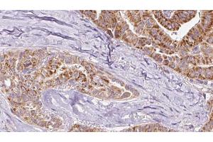 ABIN6267080 at 1/100 staining Human thyroid cancer tissue by IHC-P. (Connexin 43/GJA1 anticorps  (pTyr265))