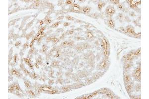 IHC-P Image Immunohistochemical analysis of paraffin-embedded human breast cancer, using ADPGK, antibody at 1:250 dilution. (ADPGK anticorps)