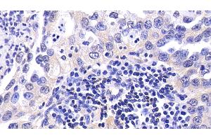 Detection of CASP9 in Human Lung cancer Tissue using Polyclonal Antibody to Caspase 9 (CASP9)