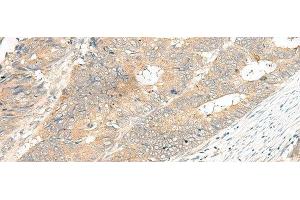 Immunohistochemistry of paraffin-embedded Human colorectal cancer tissue using GPR12 Polyclonal Antibody at dilution of 1:35(x200) (G Protein-Coupled Receptor 12 anticorps)