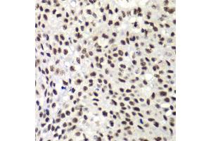 Immunohistochemistry of paraffin-embedded human lung cancer using NELFE antibody (ABIN6289947) at dilution of 1:100 (40x lens).