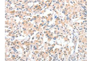 The image on the left is immunohistochemistry of paraffin-embedded Human thyroid cancer tissue using ABIN7128970(CLIP1 Antibody) at dilution 1/30, on the right is treated with fusion protein. (CLIP1 anticorps)