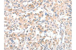 The image on the left is immunohistochemistry of paraffin-embedded Human thyroid cancer tissue using ABIN7128970(CLIP1 Antibody) at dilution 1/30, on the right is treated with fusion protein. (CLIP1 anticorps)