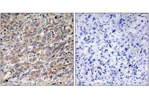 Immunohistochemistry analysis of paraffin-embedded human liver carcinoma tissue, using COX17 Antibody. (COX17 anticorps  (AA 1-50))