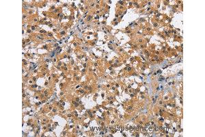 Immunohistochemistry of Human thyroid cancer using BRE Polyclonal Antibody at dilution of 1:40 (BRE anticorps)