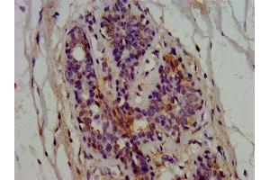 IHC image of ABIN7145566 diluted at 1:600 and staining in paraffin-embedded human breast cancer performed on a Leica BondTM system.
