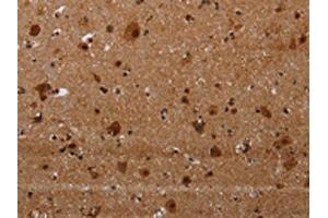 The image on the left is immunohistochemistry of paraffin-embedded Human brain tissue using ABIN7191356(MAGEE1 Antibody) at dilution 1/30, on the right is treated with synthetic peptide. (MAGEE1 anticorps)