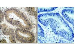 Immunohistochemical analysis of paraffin-embedded human colon carcinoma tissue using IKK a(Phospho-Thr23) Antibody(left) or the same antibody preincubated with blocking peptide(right).