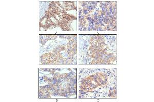Immunohistochemical analysis of paraffin-embedded human breast intraductal carcinama tissue(A) and breast infiltrating ductal carcinama tissue(B) showing membrane localization using HER-2 mouse mAb with DAB staining.