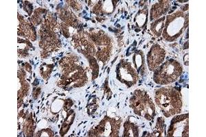 Immunohistochemical staining of paraffin-embedded Adenocarcinoma of ovary tissue using anti-AKR1A1 mouse monoclonal antibody. (AKR1A1 anticorps)