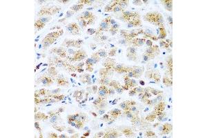 Immunohistochemistry of paraffin-embedded human liver cancer using KIAA1456 antibody at dilution of 1:200 (40x lens). (KIAA1456 anticorps)