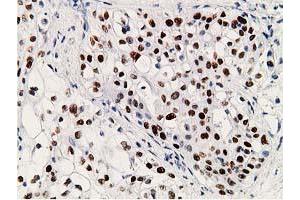 Immunohistochemical staining of paraffin-embedded Carcinoma of Human pancreas tissue using anti-TP53 mouse monoclonal antibody. (p53 anticorps)