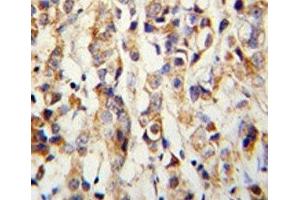 IHC analysis of FFPE human breast carcinoma with Keratin-14 antibody