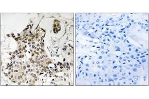 Immunohistochemistry analysis of paraffin-embedded human breast carcinoma tissue, using HP1 gamma (Ab-93) Antibody. (CBX3 anticorps  (AA 59-108))