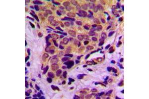 Immunohistochemical analysis of 4EBP1 (pT37) staining in human breast cancer formalin fixed paraffin embedded tissue section. (eIF4EBP1 anticorps  (N-Term, pSer37))