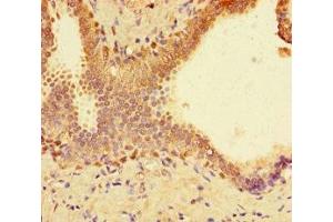Immunohistochemistry of paraffin-embedded human prostate cancer using ABIN7172704 at dilution of 1:100 (SUPT3H/SPT3 anticorps  (AA 1-328))