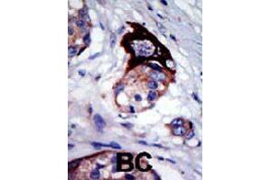 Formalin-fixed and paraffin-embedded human cancer tissue reacted with MARK3 polyclonal antibody  , which was peroxidase-conjugated to the secondary antibody, followed by AEC staining. (MARK3 anticorps  (C-Term))