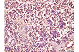 Formalin-fixed and paraffin embedded human lung carcinoma labeled with Anti-Smad1 Polyclonal Antibody, Unconjugated (ABIN732158) at 1:200 followed by conjugation to the secondary antibody and DAB staining (Smad1/5 anticorps  (AA 361-465))